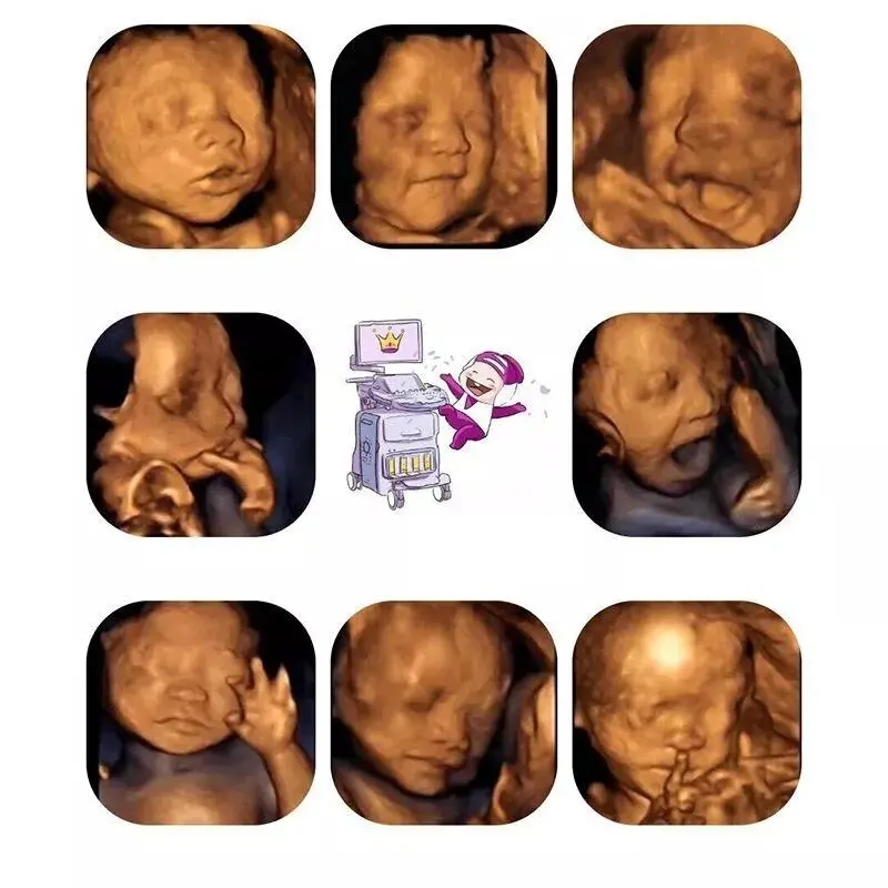 超声影像（四维彩超）系统筛查胎儿发育情况，抱团更优惠！